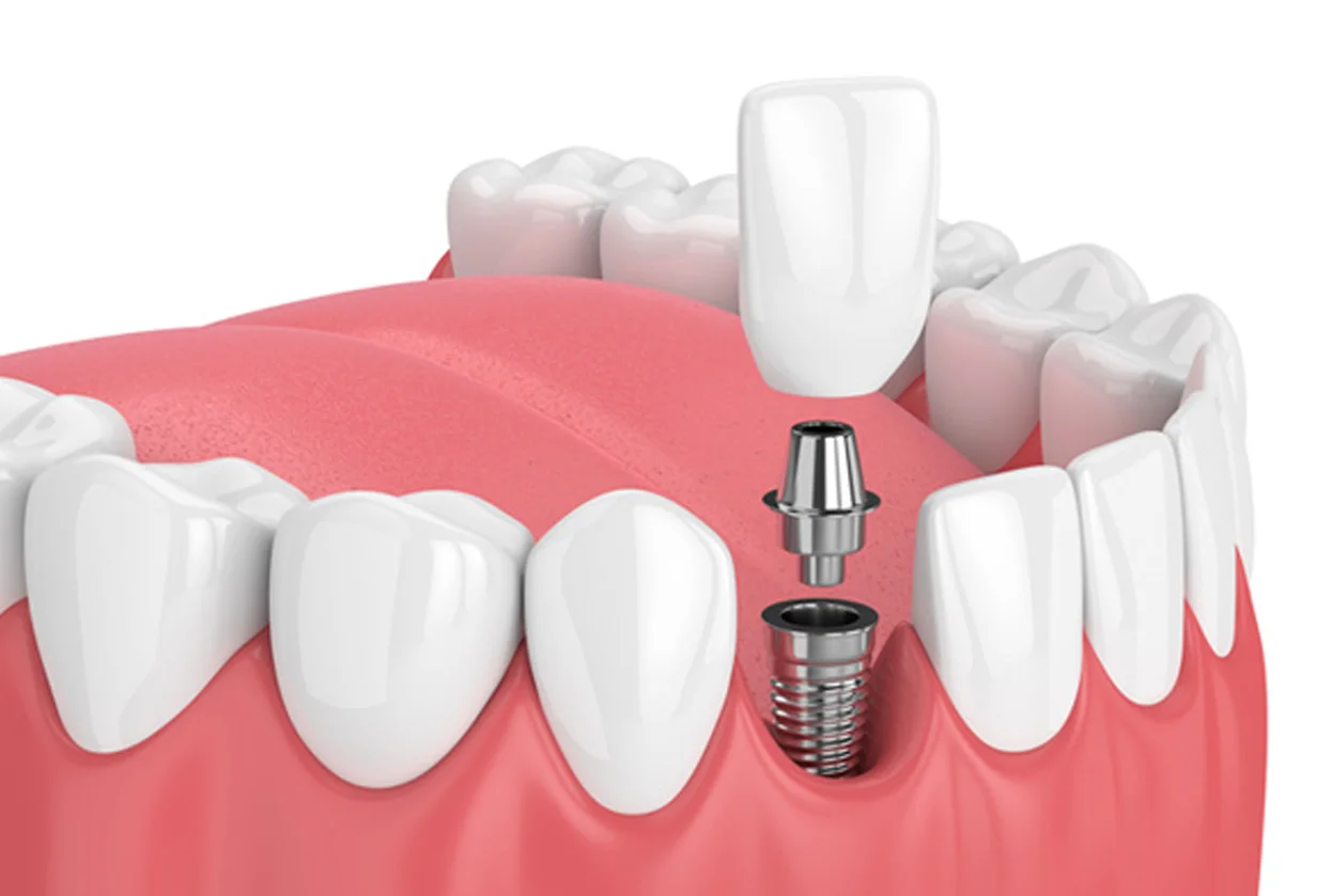 Dental Implant