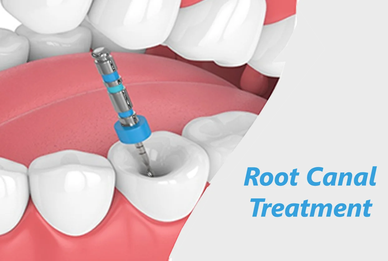 Root Canal Treatment