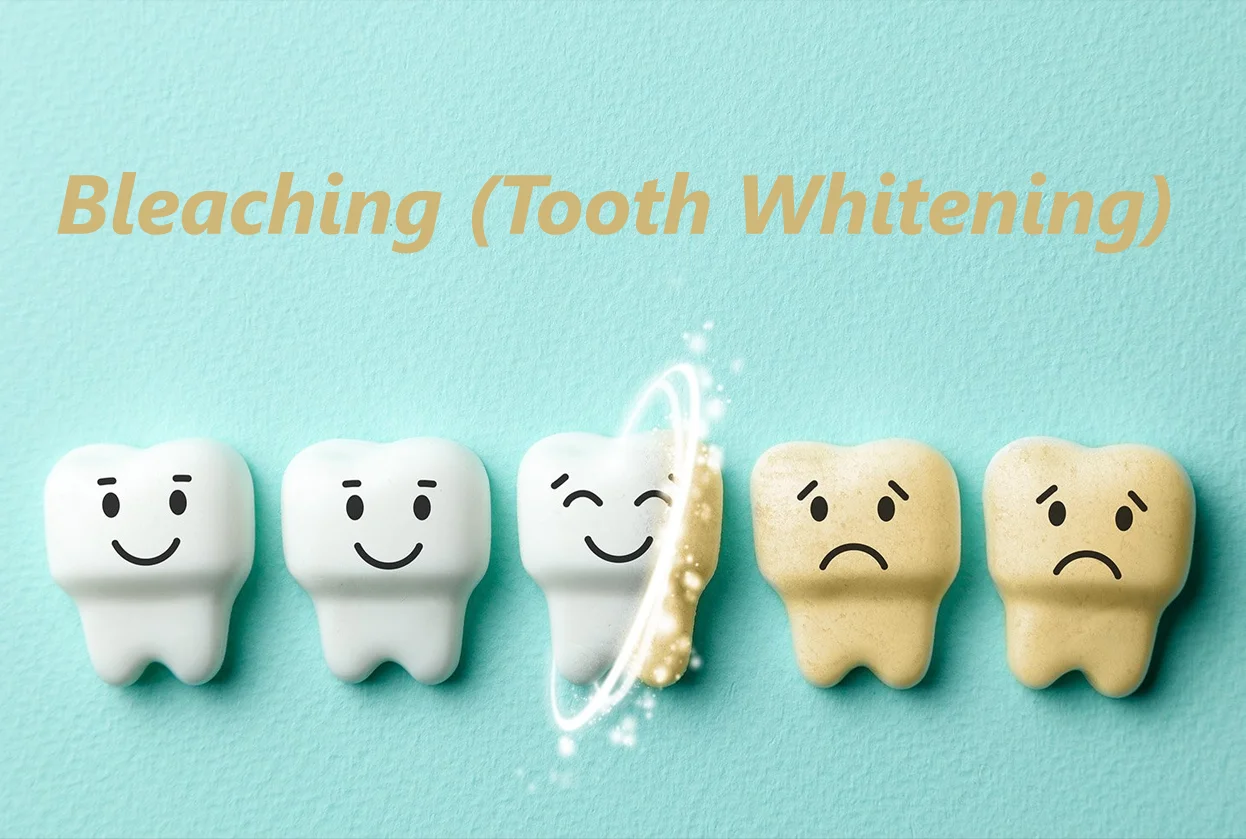 Bleaching (Tooth Whitening)