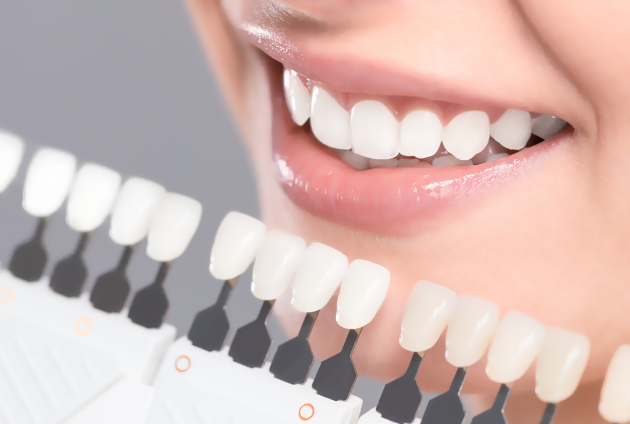 Veneer