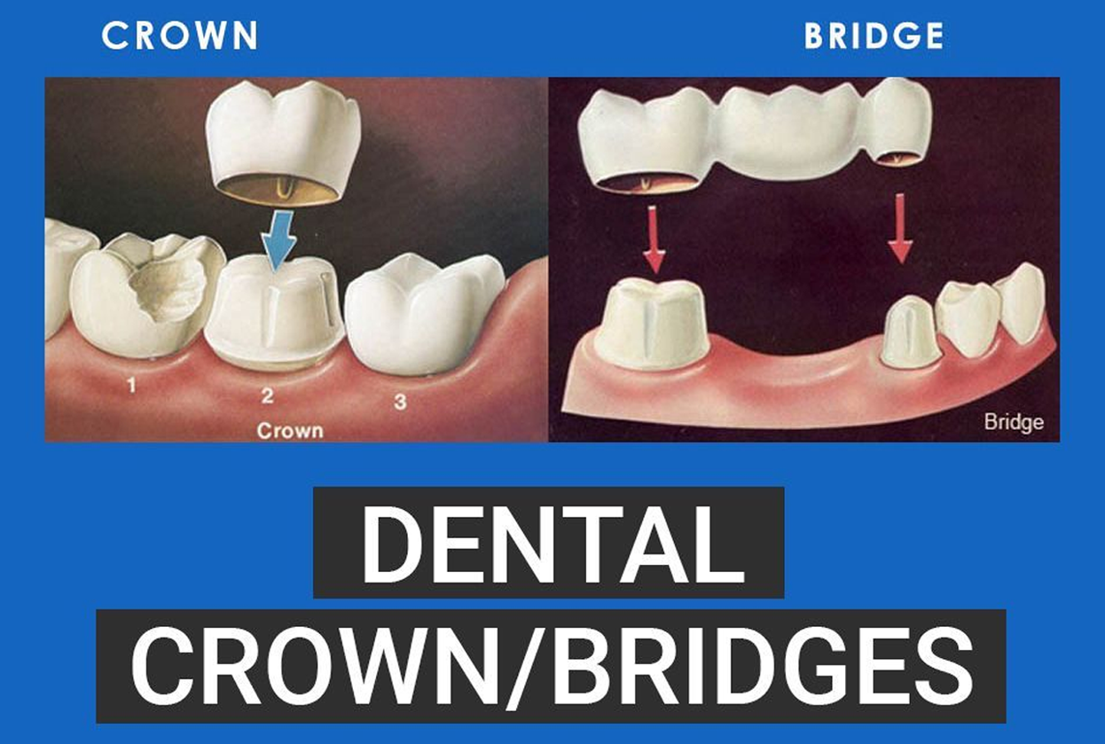 Crown & Bridge