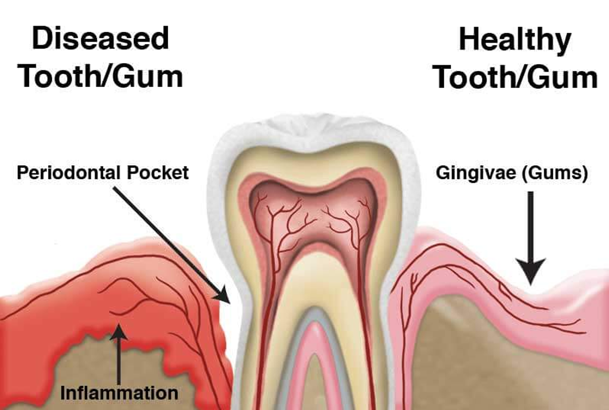 Treatment of Gum Disease